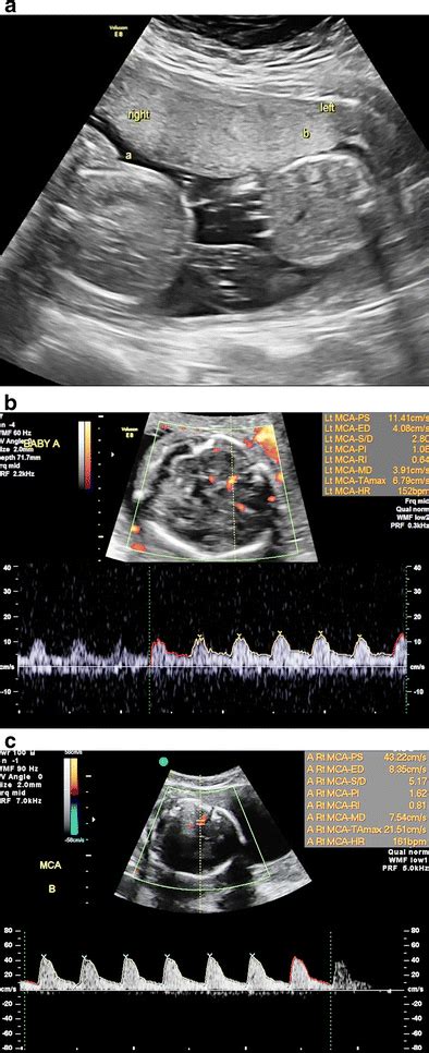 Selective Intrauterine Growth Restriction And Twin Anemia Polycythemia