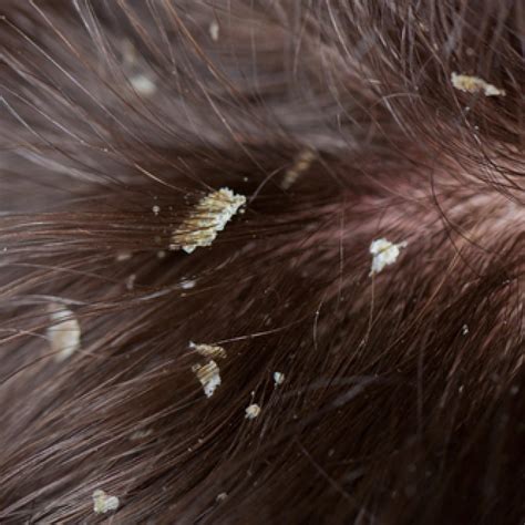 The Itchy Facts About Dandruff Gethair