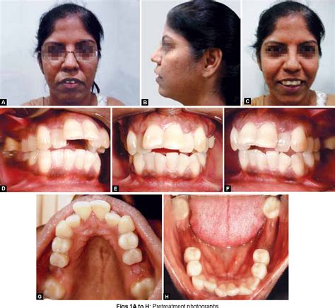 Figure 1 From Interdisciplinary Management Of An Adult Patient With Class Ii Div 1 Malocclusion