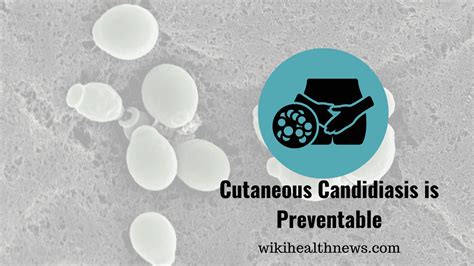 Cutaneous Candidiasis Preventable Infection Wiki Health News