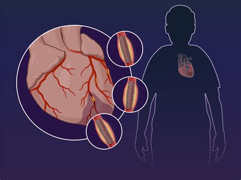 Complete Pci In Older Patients With Myocardial Infarction New England