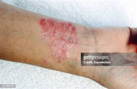 270 Psoriasis Arm Stock Photos, High-Res Pictures, and Images - Getty ...