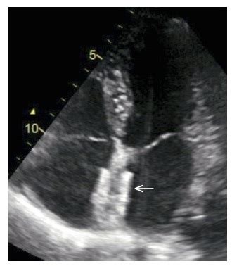 Prevención secundaria de ACV en los enfermos con foramen oval permeable