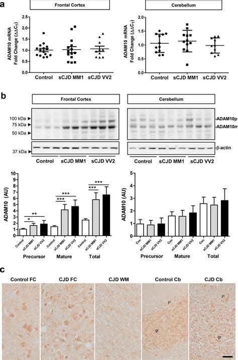 ADAM10 Expression In SCJD Brain Tissue A RT QPCR Analysis Of ADAM10 In