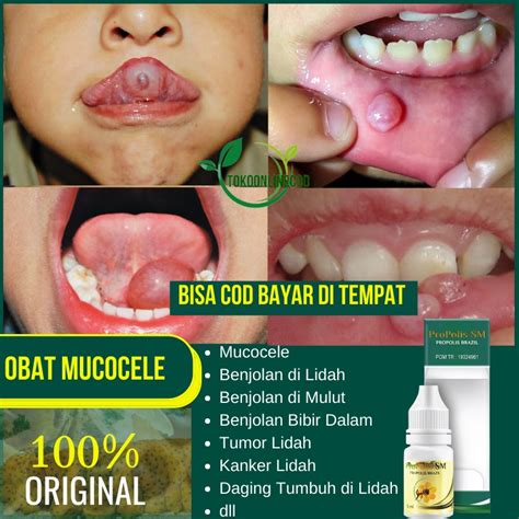 Jual Obat Mucocele Benjolan Di Lidah Benjolan Di Mulut Benjolan Di Bibir Dalam Tumor Lidah