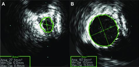 A Intravascular Ultrasound Ivus Measures Of The Left Common Iliac Download Scientific