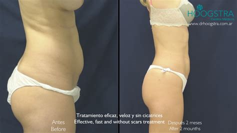 Lipoescultura Laser Sin Cirug A Modela Tu Cuerpo Hoogstra Buenos Aires