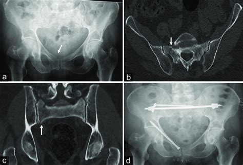 A A 79 Year Old Female Suffers A Ramus Superior And Inferior Fracture Download Scientific