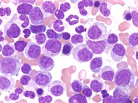 chronic myelogenous leukemia