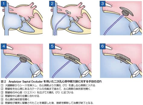 心房中隔欠損のカテーテル治療 Amplatzer 低侵襲治療の紹介 慶應義塾大学病院 心臓血管低侵襲治療センター Keio