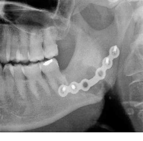 Osteonecrosi Da Bifosfonati Della Mandibola Con Disodontiasi Del 3 8