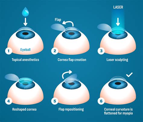 Lasik Surgery Chicago Lasik Niles Milwaukee Avenue Eye