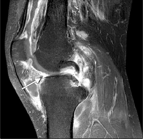 Sagittal T Weighted Enhanced Fat Suppressed Magnetic Resonance Image