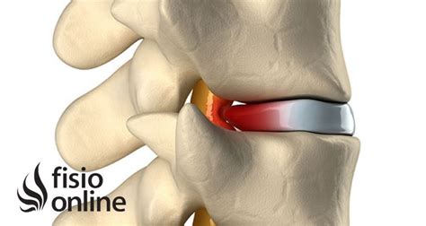 Hernia Discal Central A Nivel L5 S Causas Síntomas Y Tratamiento En Fisioterapia Fisioonline