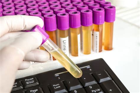 Urine Test To Look For Abnormalities From Urine Urine Sample To