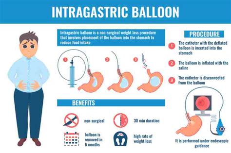 Palloncino Per Dimagrire Vediamo In Cosa Consiste L Intervento E Di