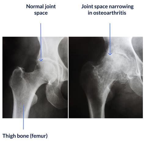 Anatomy, osteoarthritis and total hip replacement surgery – Support orthopedics – moveUP