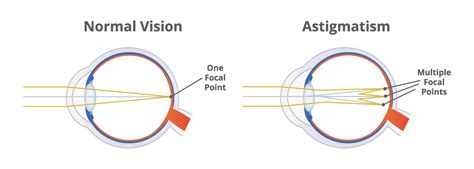 Astigmatism Hinsdale | Pediatric Ophthalmology Wheaton, IL