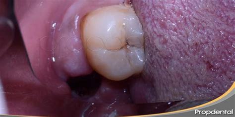 Infecciones dentales tras una extracción de muela Qué debes hacer