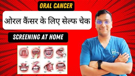 Dr Rudra Mohan मुख कैंसर के लिए आत्म मौखिक जांच करें Mouth Self Screening For Oral Cancer At