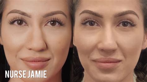 Before And After Non Surgical Nose Job Nurse Jamie Youtube