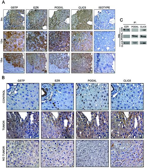 Co Localization Of EZR CLIC5 And PODXL In Tumors Of Rat Livers After