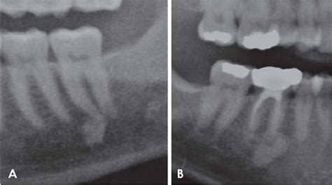 Maxillary Sinus Polyp Semantic Scholar