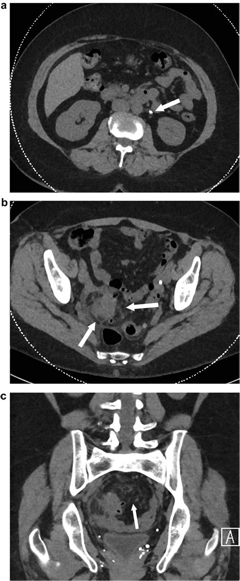 66 year old female presenting with hypogastric pain with bilateral ...