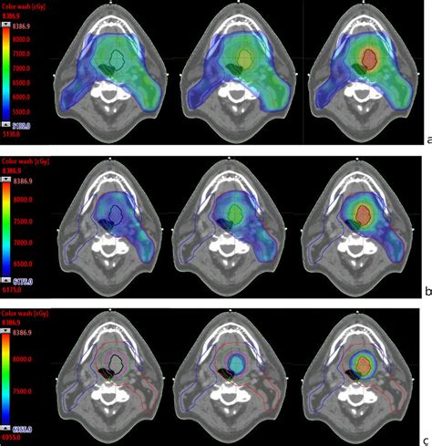 Examples Of Colour Wash Dose Distributions On CT Axial Slices A