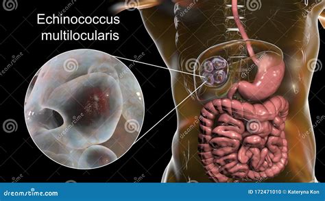 Echinococcus Cysts