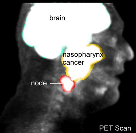 Nasopharynx Cancer Anatomy And Images