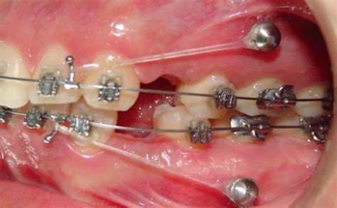 Qué son los microimplantes dentales para ortodoncia Branz Ortodoncia