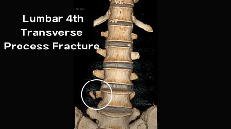 Lumbar Disc And Bone With 4th Transverse Process Fracture Youtube