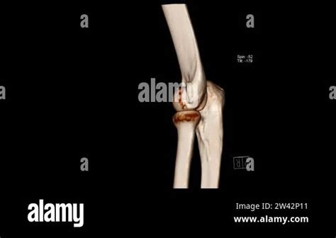 Radiology Examination Computed Tomography Volume Rendering Examination