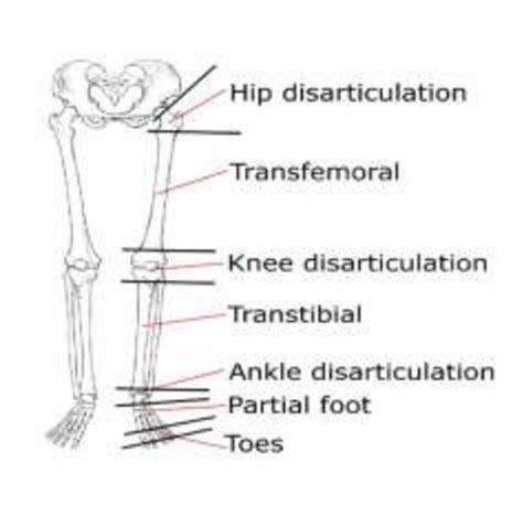 Levels Of Amputation Of The Lower Extremity Download Scientific Diagram Porn Sex Picture