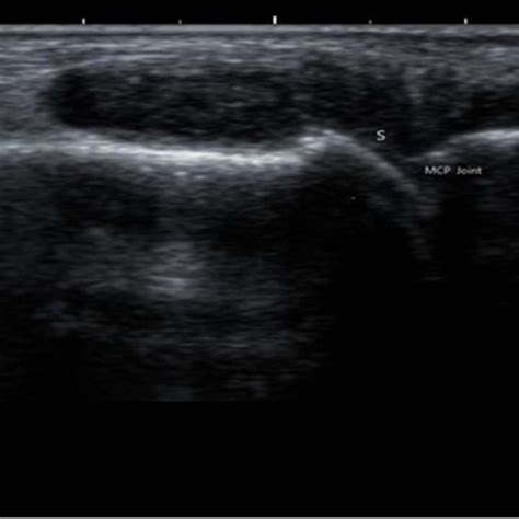 Gray Scale Us Long Axis View Of Mcp Joint Of Right Index Finger Of The Download Scientific