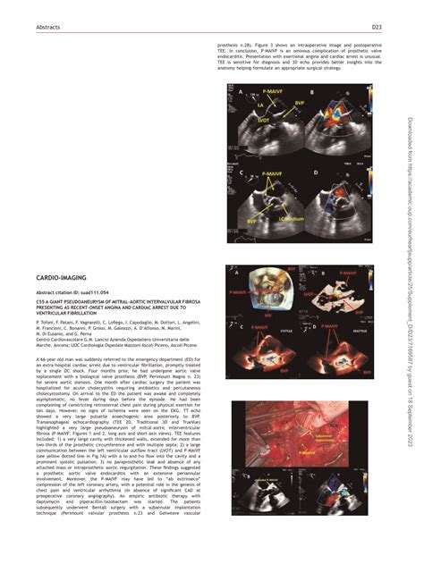 PDF C55 A GIANT PSEUDOANEURYSM OF MITRALAORTIC INTERVALVULAR FIBROSA