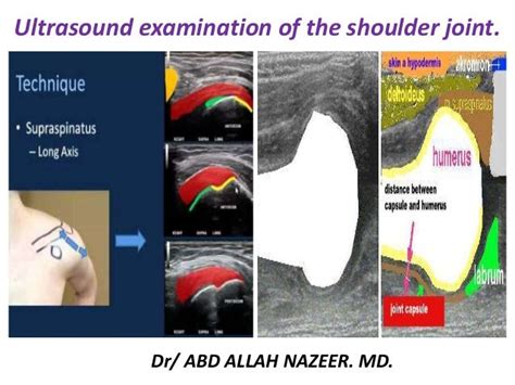 Shoulder Ultrasound Anatomy