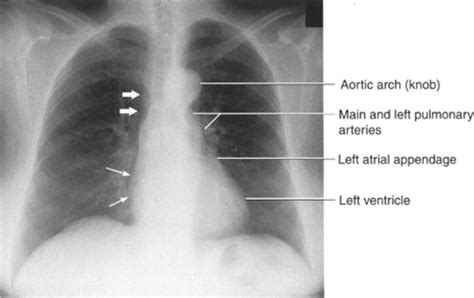 Chest Radiography Flashcards Quizlet