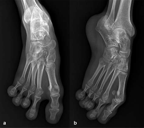 Figure 4 From Association Of Upper Limb Meromelia Proximal Focal