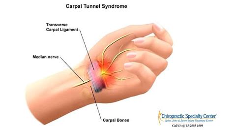 Carpal Tunnel Syndrome & Wrist Pain Assessment