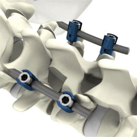 Thorako lumbales Stabilisierungssystem für Osteosynthese S4