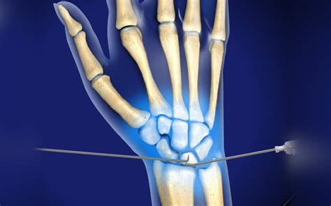 Wrist arthroscopy | S J Plastic Surgery