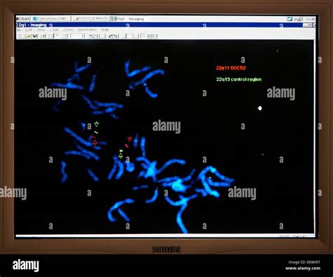 FISH (Fluorescent in situ hybridization) technique to detect the deletion of a small piece of ...