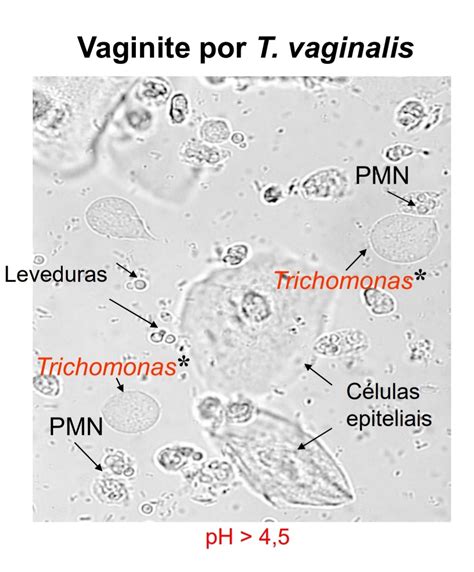 Ginecologia e Obstetrícia: Tricomoníase: sintomas, diagnóstico e tratamento