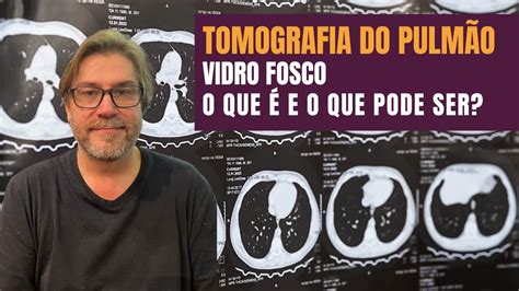 Opacidade em vidro fosco na tomografia do pulmão o que é e principais