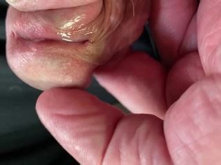 A Trip Into The Glans Hypospadias Pornhub Gay