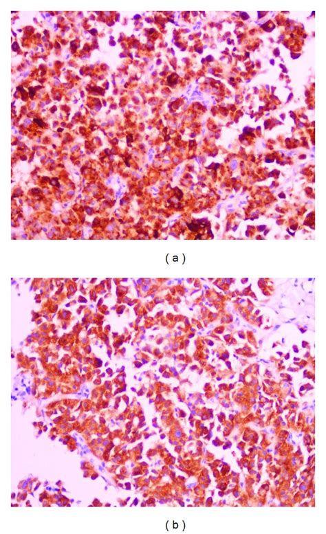 Immunohistochemistry Staining Positive For Chromogranin A And