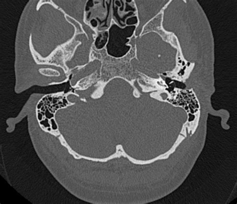 File:Petrous bone trauma - fracture, ossicular dislocation and ...