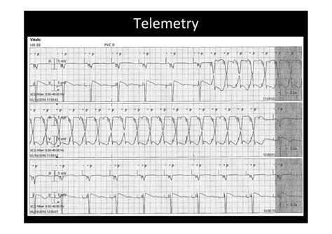 Pacemaker Mediated Tachycardia Or Not Ppt